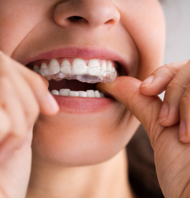 Caring for Your Aligners at BeauDent Family Dental in Beaumont